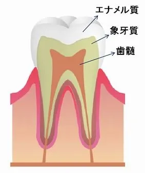 むし歯ってなに？