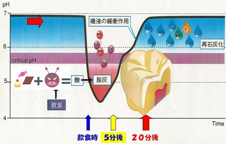 むし歯の原因・キッカケ