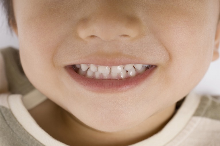 子どもの矯正歯科のメリット