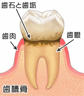 歯周ポケット　3mm以内。歯茎の縁が炎症を起こした歯肉炎。歯磨きをすると出血する。口臭があるなどの症状があります。