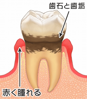 歯周ポケット　3mm以上～5mm以内。歯を触ると前後に動き、歯垢がたまる「歯周ポケット」ができ、歯槽骨が溶けはじめます。出血も多くなります。　