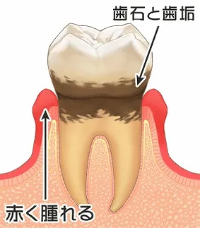 歯周ポケット　3mm以上～5mm以内。歯を触ると前後に動き、歯垢がたまる「歯周ポケット」ができ、歯槽骨が溶けはじめます。出血も多くなります。　