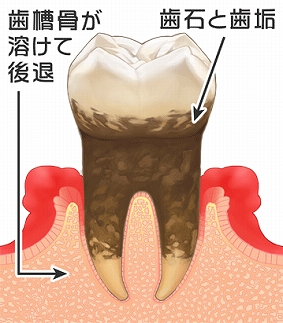 歯周ポケット　5mm以上～7mm以内。歯槽骨がさらに溶け、出血や膿が多くなり、口臭がきつくなります。歯が前後、左右に動きます。